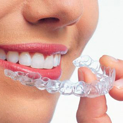 invisalign